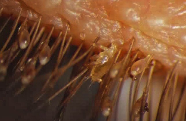 Eyelash Mites Pictures Symptoms Causes Prevention Treatment 