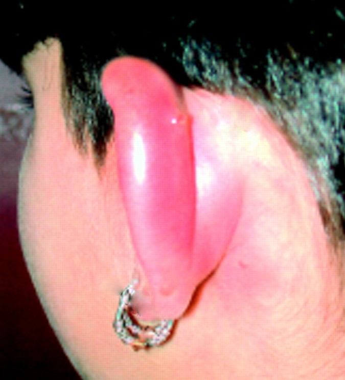 Cartilage Piercing - Ear, Bump, Pictures, Infection and ...