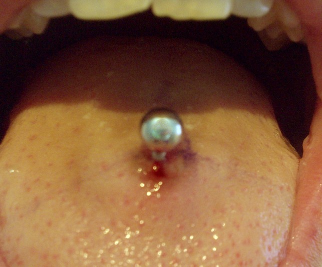 Infected Tongue Piercing Signs And Symptoms Causes