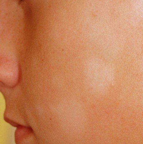 What are the causes of white patches of skin?