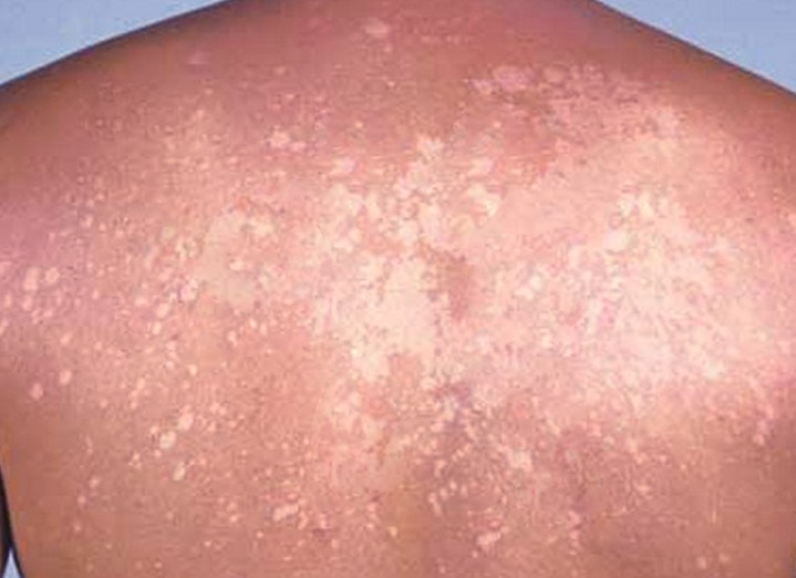 What are the causes of white patches of skin?