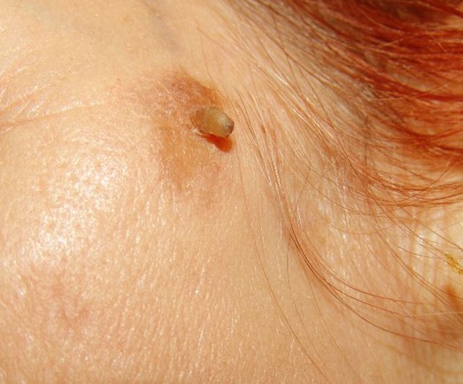 Picture of Cutaneous Horns - WebMD
