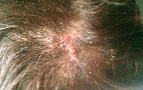 Itchy Scalp With Red Bumps - Doctor answers on HealthTap