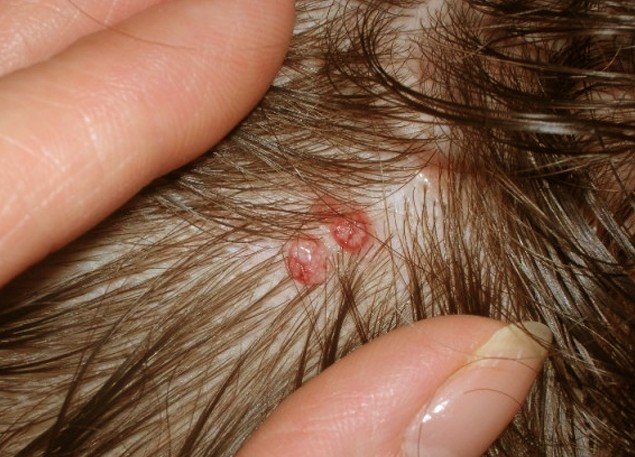 small itchy bumps on scalp - Dermatology - MedHelp