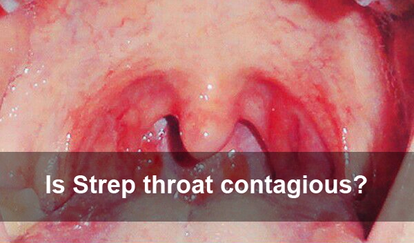 What are the symptoms of strep throat?
