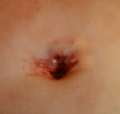belly button discharge