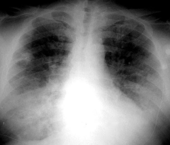 diffuse pulmonary hemorrhage