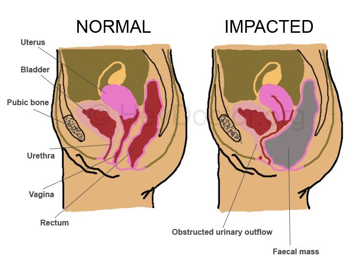 impacted bowel pictures