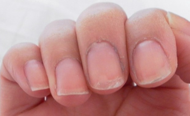 peeling nails pictures 2