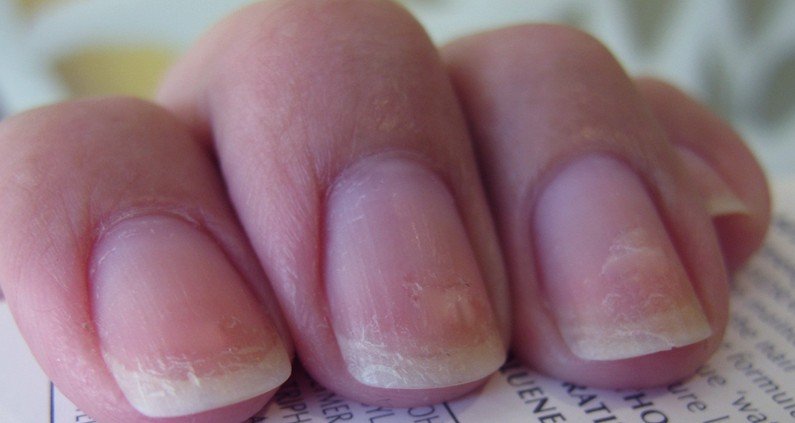 The 6 Most Annoying Problems You Have With Your Nails And How To Fix Them Stellar