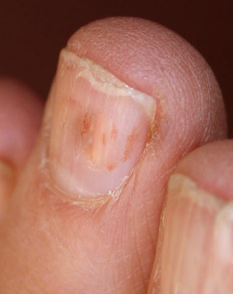 peeling nails