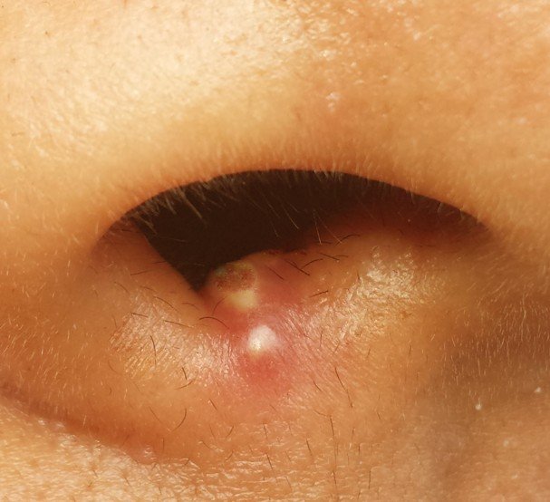 pimple in nose