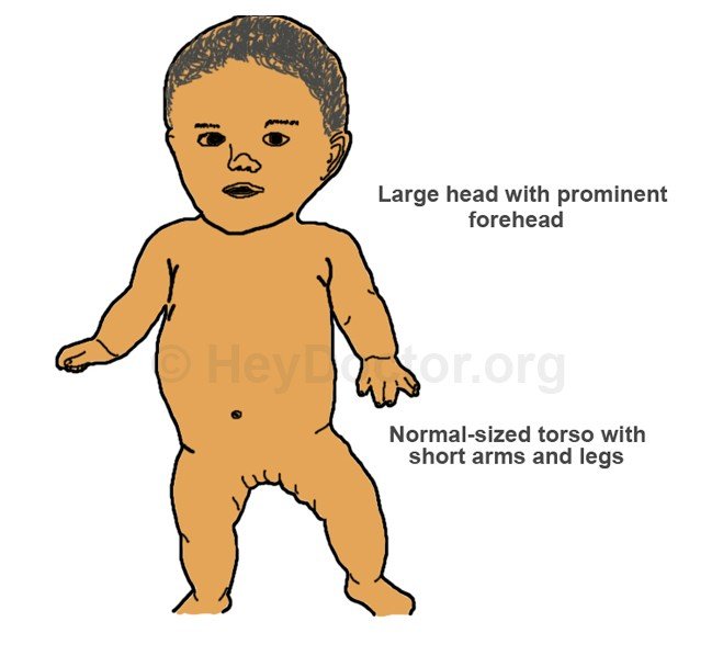 Dwarfism Chart