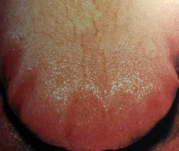scalloped tongue