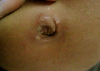 smelly belly button caused by sebaceous cyst