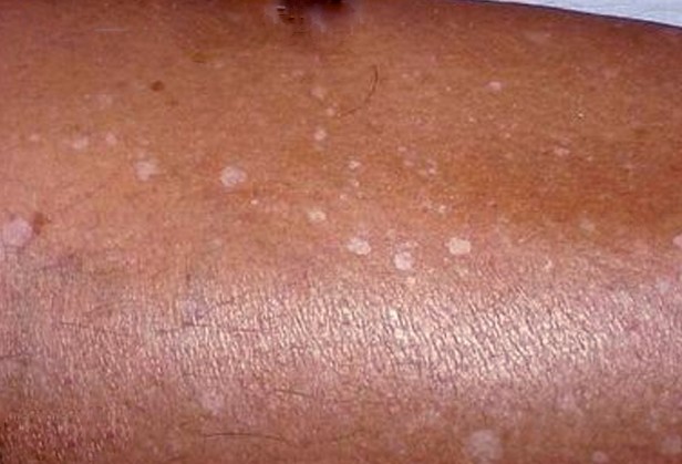 white spots on skin idiopathic guttate hypomelanosis