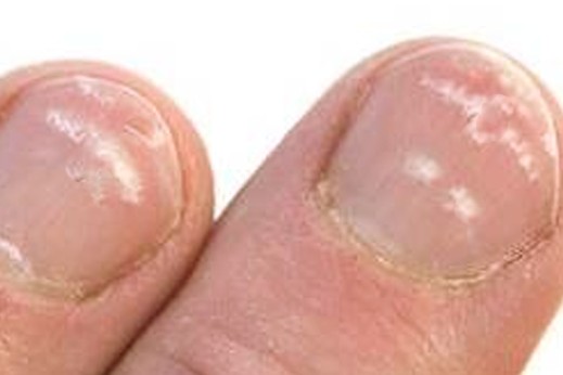 white spots on toenails pictures 2