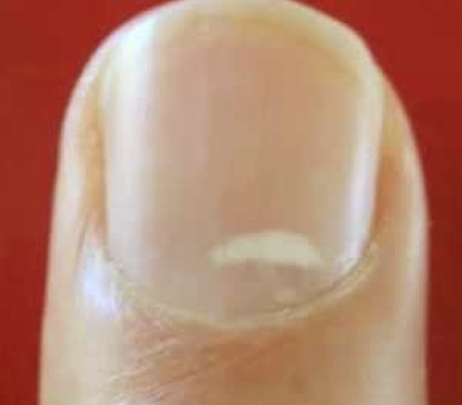 white spots on toenails pictures