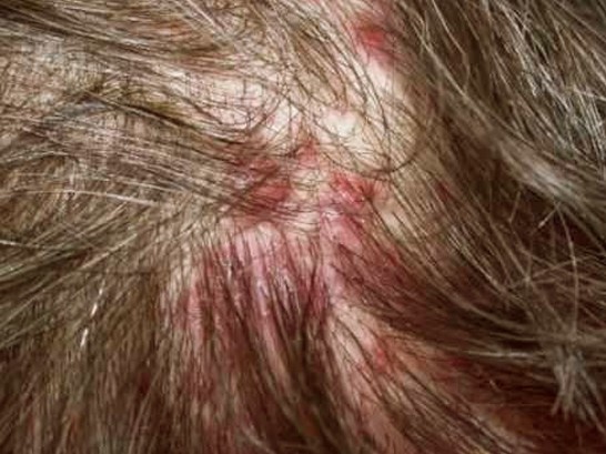 itchy bumps on scalp pictures 2