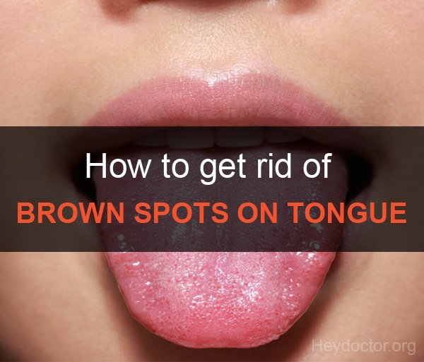 how to get rid of brown spots on tongue