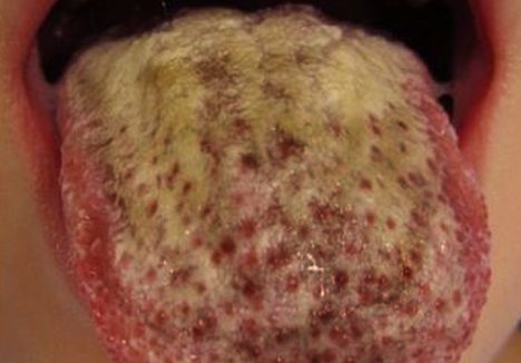 Brown Spots on Tongue - Causes, Treatment and, Pictures