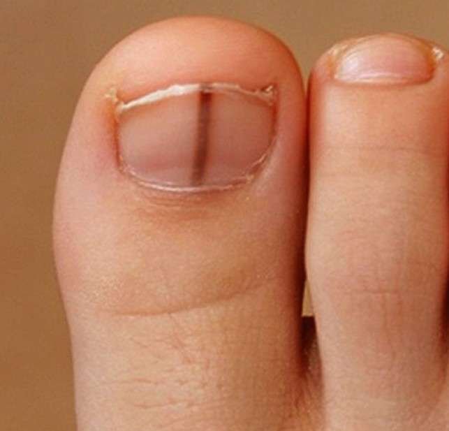 melanoma-under-nail-symptoms-doctor-heck