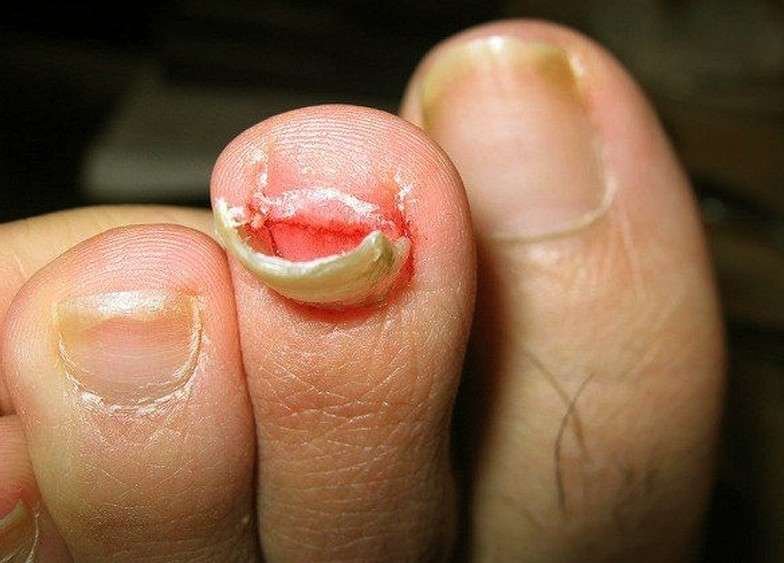 to nail how a remove fungi Remedies, Falling Treatment,  Pics Toenail off  Home Causes,