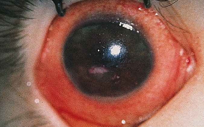 xerophthalmia.jpg